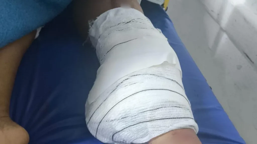 Diarista tem perna amputada após acidente; família busca motorista