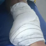 Diarista tem perna amputada após acidente; família busca motorista