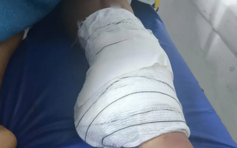 Diarista tem perna amputada após acidente; família busca motorista