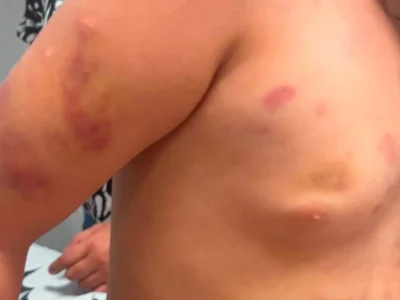 Padrasto preso após criança autista de 6 anos dar entrada ferida em hospital